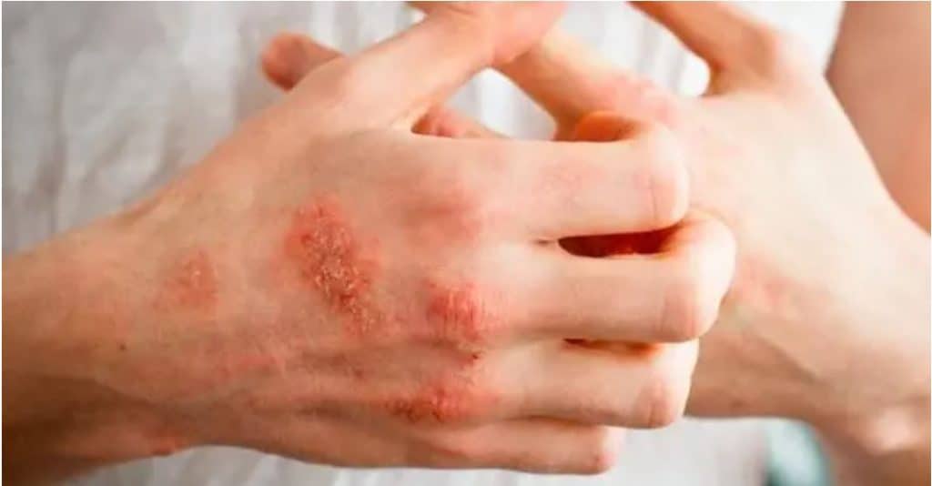 problemi zima ispucale ruke tretman