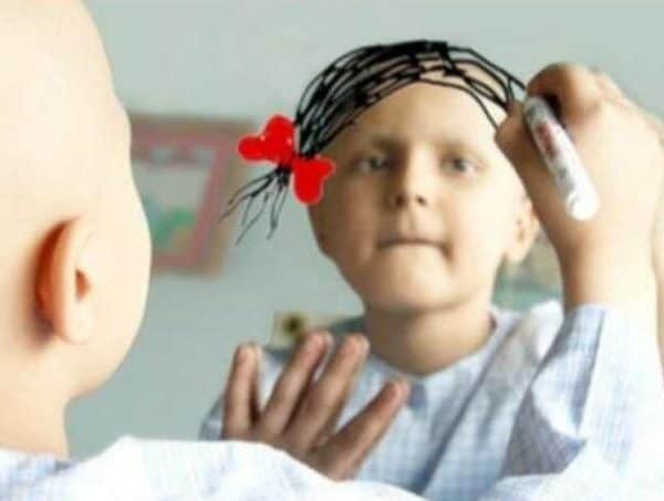 djeca, karcinom, tuzla